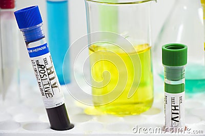 Hiv and aids infection blood test sample, diagnoses and laboratory chemical liquid elements Stock Photo