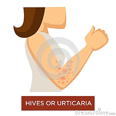 Hives or urticaria disease skin inflammation immune system damage Vector Illustration