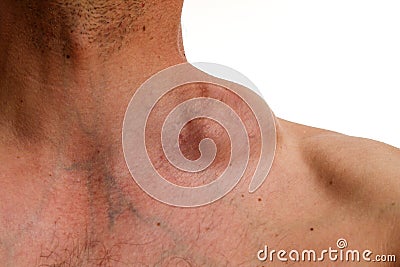 Hodgkin tumor - Bulky tumour - Hodgkin lymphoma Stock Photo