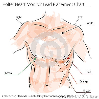 Holter Heart Monitor Lead Placement Chart Vector Illustration