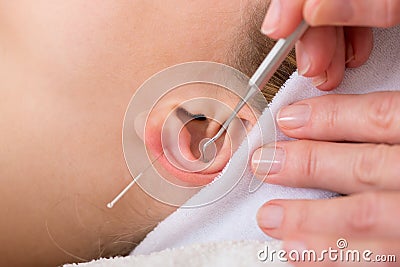 Homeopath treating woman with acupuncture. Stock Photo