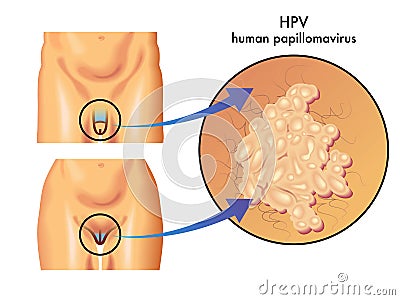 HPV (human papillomavirus) Vector Illustration