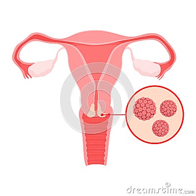 HPV infection of uterine cervix Vector Illustration