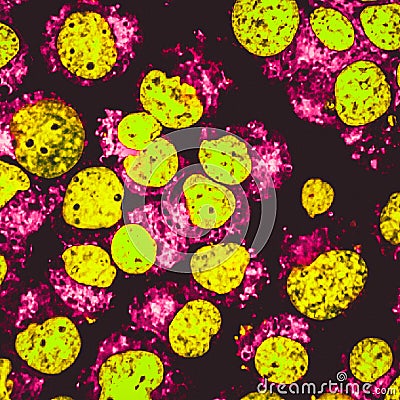 Human acute leukemia cell line nuclei colored in yellow Stock Photo