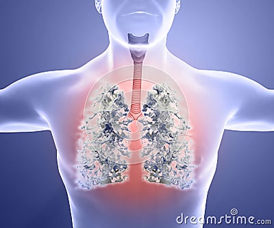 Human anatomy, problems with the respiratory system, severely damaged lungs. Bilateral pneumonia Stock Photo