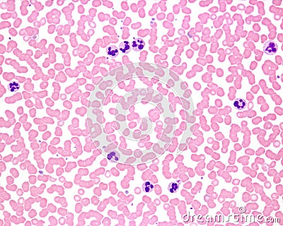 Human blood smear. Leukocytosis Stock Photo
