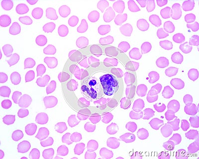 Human blood smear. Neutrophil and monocyte Stock Photo