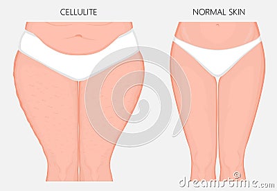 Human body problem_Cellulitis and weight loss front view Vector Illustration