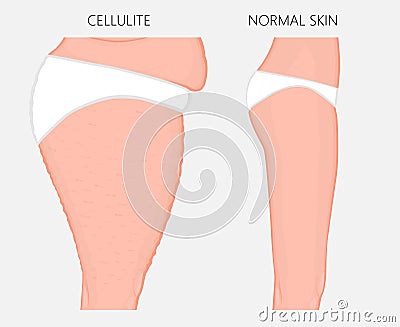 Human body problem_Cellulitis and weight loss side view Vector Illustration