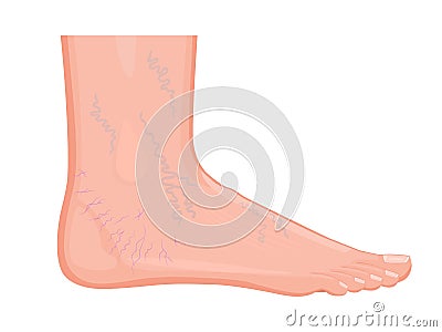 Human body problem_Spider Veins On The Feet & Ankles Vector Illustration