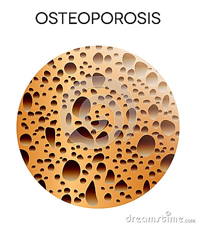 Human bone disease- osteoporosis Vector Illustration