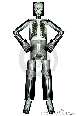 Human bone stand and akimbo (X-ray whole body) Stock Photo