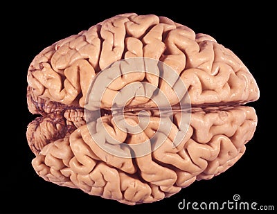Human brain. Atrophy of cerebral cortex Stock Photo