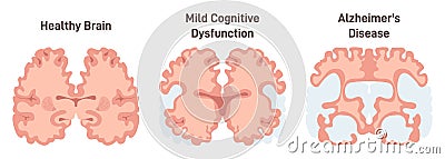 Human brain MRI scan. Healthy and Alzheimer's disease brain Cartoon Illustration