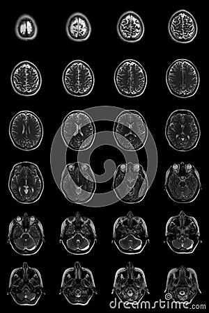 Human brain on MRI scans Stock Photo