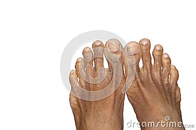 Human Dry Skin Feet In White Background Stock Photo