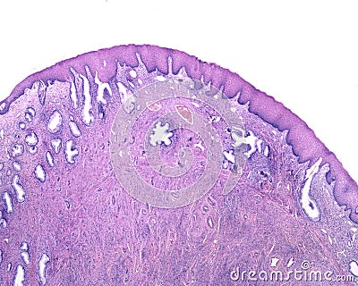 Human endocervix. Squamous metaplasia Stock Photo