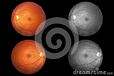 Human eye anatomy, retina, optic disc artery and vein etc. Stock Photo