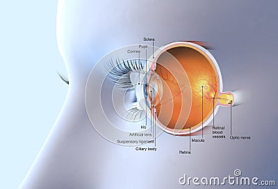 Human eye with artificial lens, medically 3D illustration Cartoon Illustration