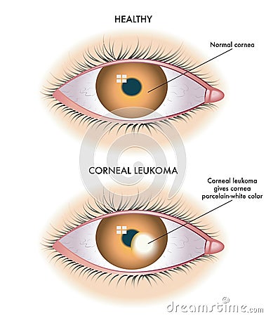 Corneal Leukoma medical illustration Vector Illustration