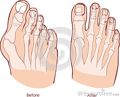 Human foot deformity. Vector Illustration