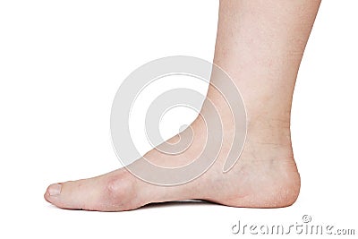 Human foot with hallux valgus Stock Photo