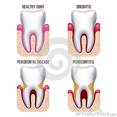 Human gum disease, gums bleeding. Tooth prevention dental, oral care vector infographics Vector Illustration