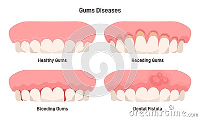 Human gum diseases set. Gums bleeding, receding and fistula. Vector Illustration