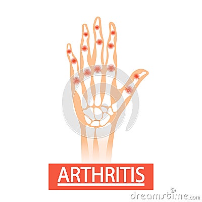 Human Hand with Arthritis Medical Vector Illustration. Swollen, Distorted Hand With Limited Mobility Vector Illustration