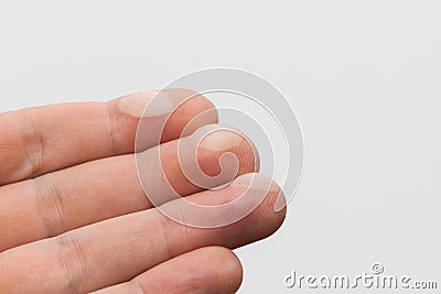 Human hand with painful blisters on three fingertips from touching hot pan isolated on white background Stock Photo