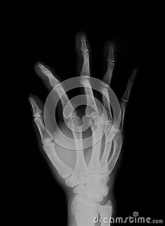 Human hand Xray Negative Scan Stock Photo