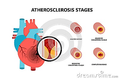 Human heart anatomy with atherosclerotic plaque. Cholesterol plaque in the blood vessels. Vector Illustration