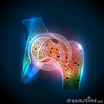 Human hip joint and Osteoporosis Vector Illustration