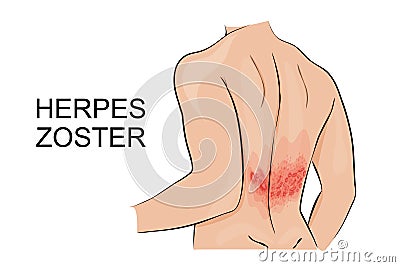 Human infection herpes zoster Vector Illustration