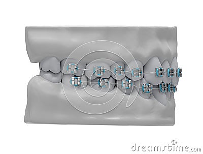 classic metal braces, side view Stock Photo