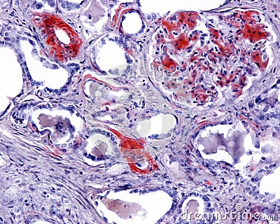 Human kidney. Amyloidosis, Congo red Stock Photo