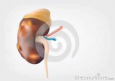 Human Kidney presents a medical concept as a organ that has the formation of painful minerals as a medical symbol with visual Vector Illustration