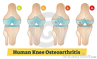 Human Knee Osteoarthritis diagram illustration Vector Illustration