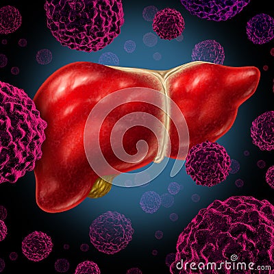 Human Liver Cancer Stock Photo
