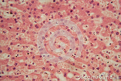 Human liver cells with tuberculosis under the microscope Stock Photo