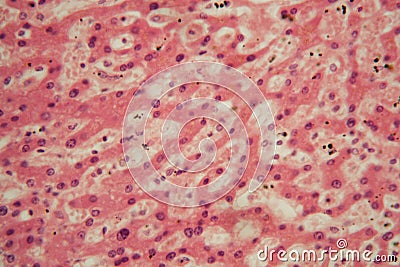 Human liver cells with tuberculosis under the microscope Stock Photo