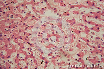 Human liver cells with tuberculosis under the microscope Stock Photo