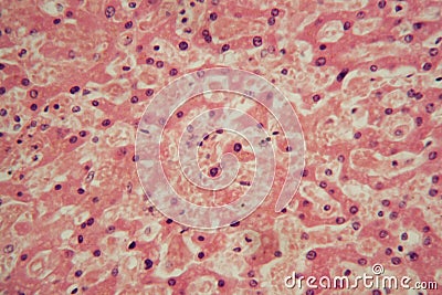 Human liver cells with tuberculosis under the microscope Stock Photo