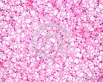 Human liver. Glycogenosis Stock Photo