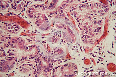 Human lung tissue with Pulmonary embolism under a microscope Stock Photo