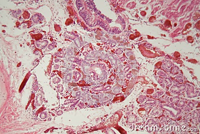 Human lung tissue with Pulmonary embolism under a microscope Stock Photo