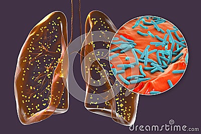 Human lungs affected by miliary tuberculosis, and close-up view of Mycobacterium tuberculosis, 3D illustration Cartoon Illustration