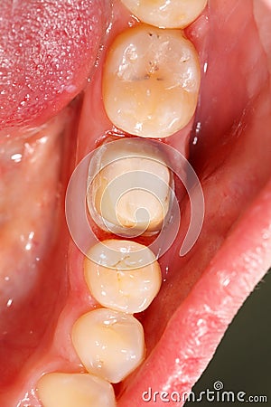 Molar Prepared For Dental Crown Stock Photo