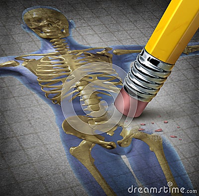 Human Osteoporosis Cartoon Illustration