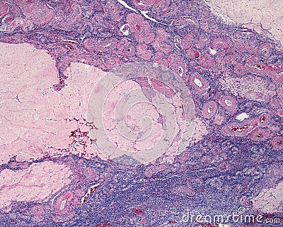 Human ovary. Corpus albicans and ovarian stroma Stock Photo